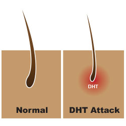 дигидротестостерон DHT действует на волосы